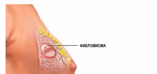 Отличительные признаки миомы грудной железы, причины и диагностика