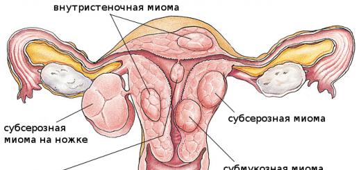 Фибромиома матки — причины и симптомы заболевания, диагностика, методы лечения и профилактика Беременность при фибромиоме: от чего зависит прогноз