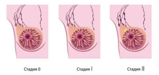 Стадии, типы и лечение рака молочной железы Можно вылечить рак молочной железы 2 степени